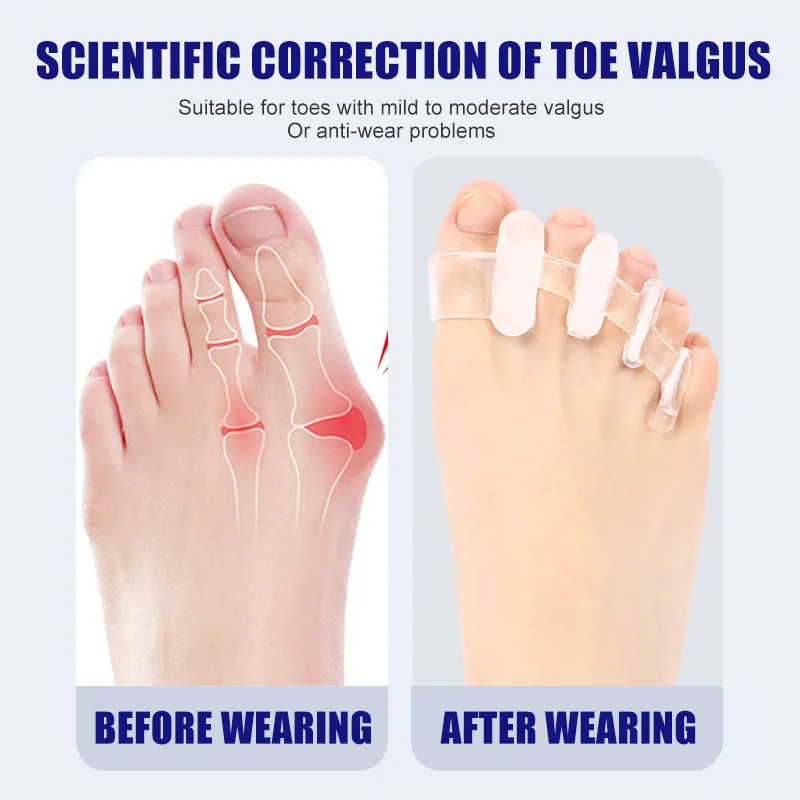 1 คู่ซิลิโคน Toe Separator Bun - Toe Separator Silicon บทวิจารณ์และราคา