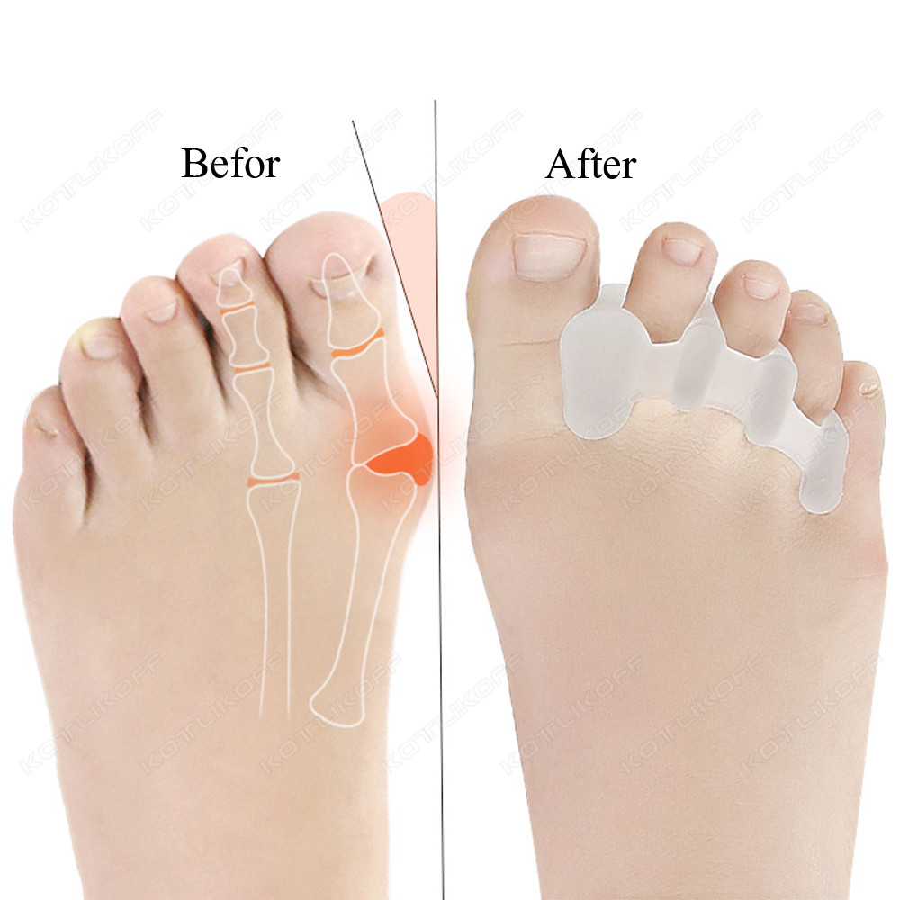 Toe ป้องกันนิ้วเท้าแยกซิลิโคน  - Toe Separator Silicon บทวิจารณ์และราคา