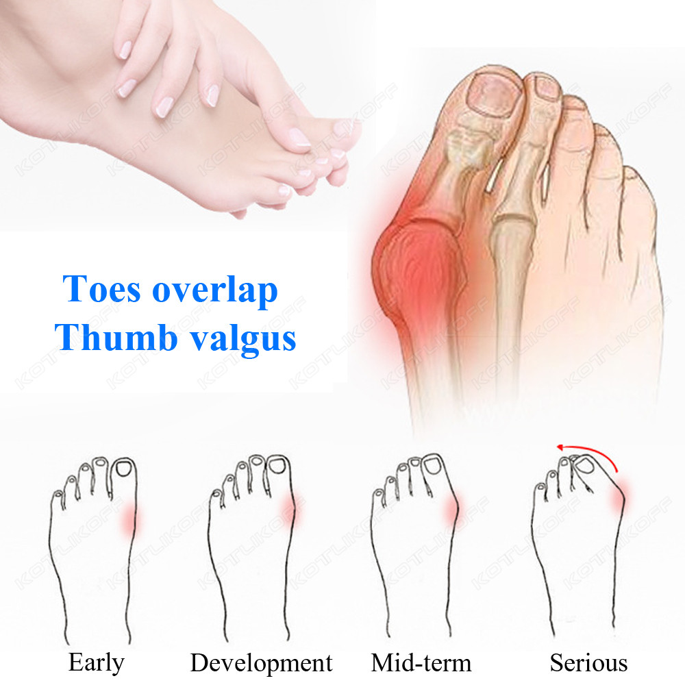 Toe ป้องกันนิ้วเท้าแยกซิลิโคน  - Toe Separator Silicon บทวิจารณ์และราคา
